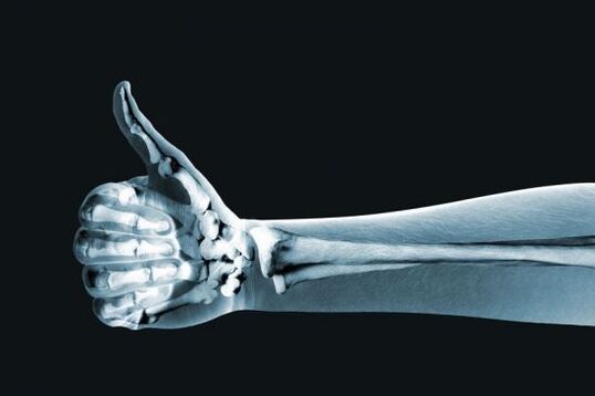 Ακτινογραφία που χρησιμοποιείται για τη διάγνωση του πόνου στις αρθρώσεις των δακτύλων