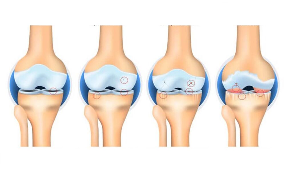 Στάδια οστεοαρθρίτιδας της άρθρωσης του γόνατος